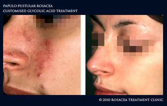 best of Treatment Glycolic acid facial