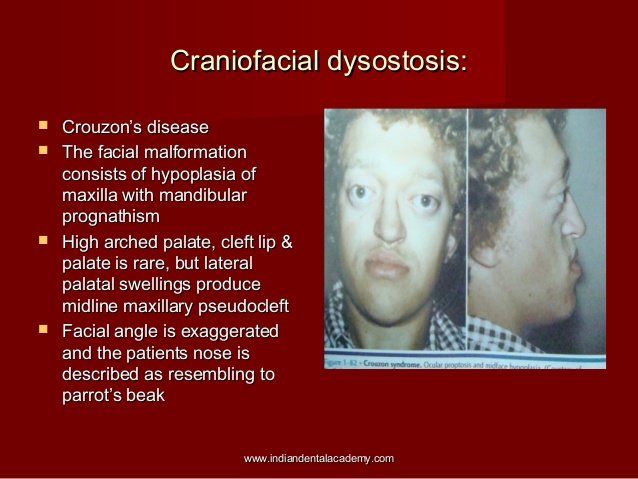 Cranio facial dysostosis