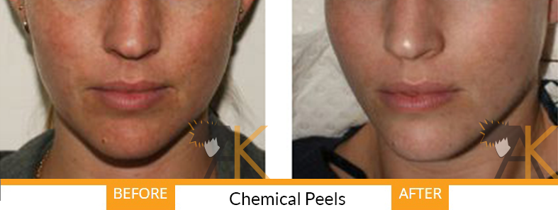 best of Chemical peel treatments laser Facial