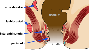 Hernia in anus
