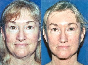 best of After facial surgery Exercise