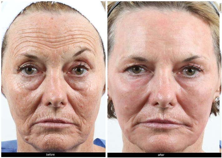 Paris reccomend Severely dry facial skin and laser
