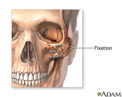 Facial bone graft