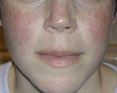 Halfback reccomend Facial erythema facial edema lupus