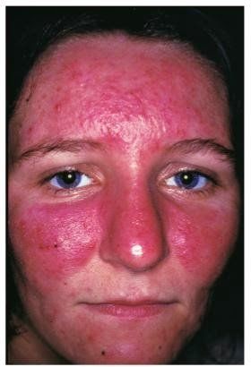 Facial erythema facial edema lupus