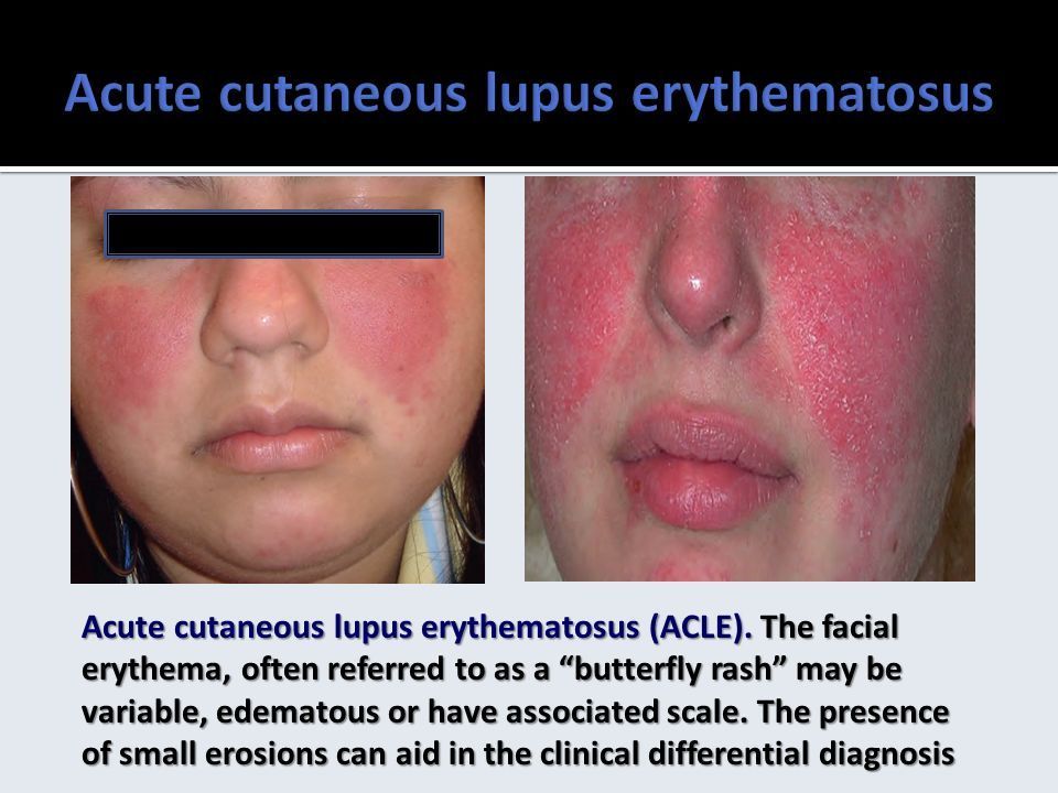 Crusher reccomend Facial erythema facial edema lupus