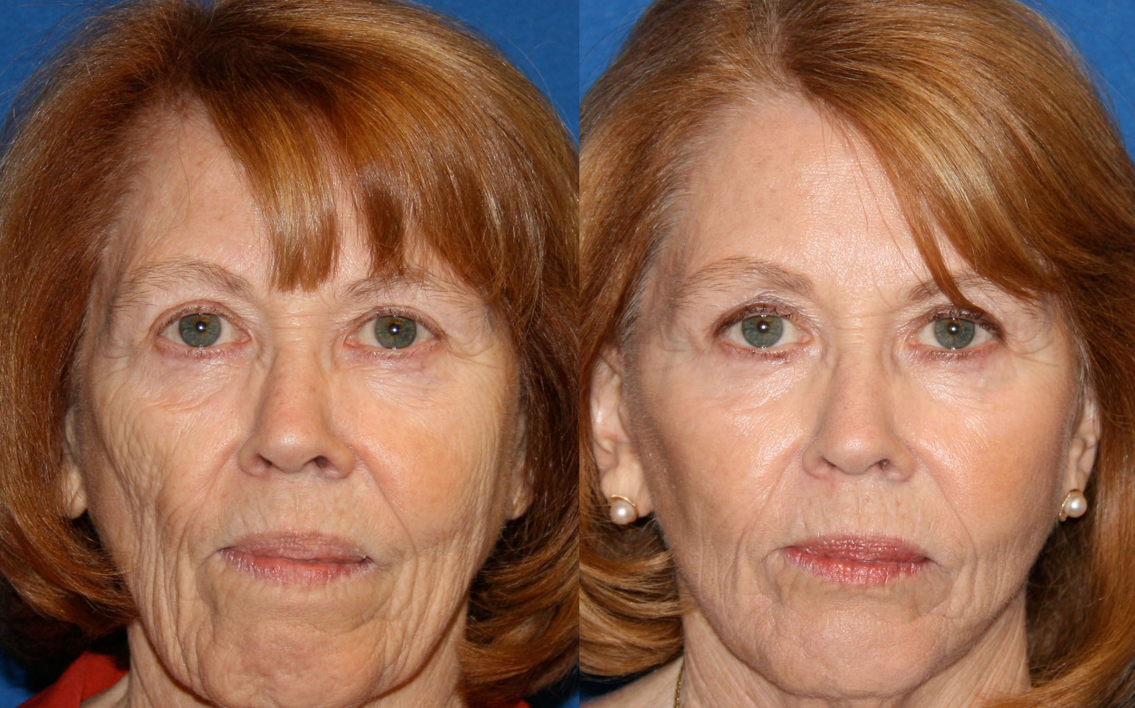 Tailgate reccomend Facial fat grafts injections