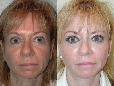 Facial fat grafts injections