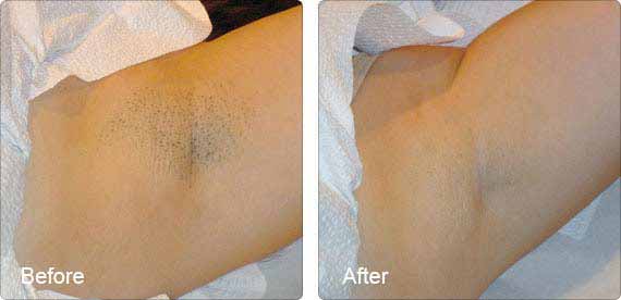 Motor reccomend Laser hair removal and bikini and cost