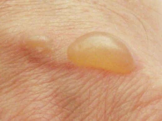 Painful blister on vulva