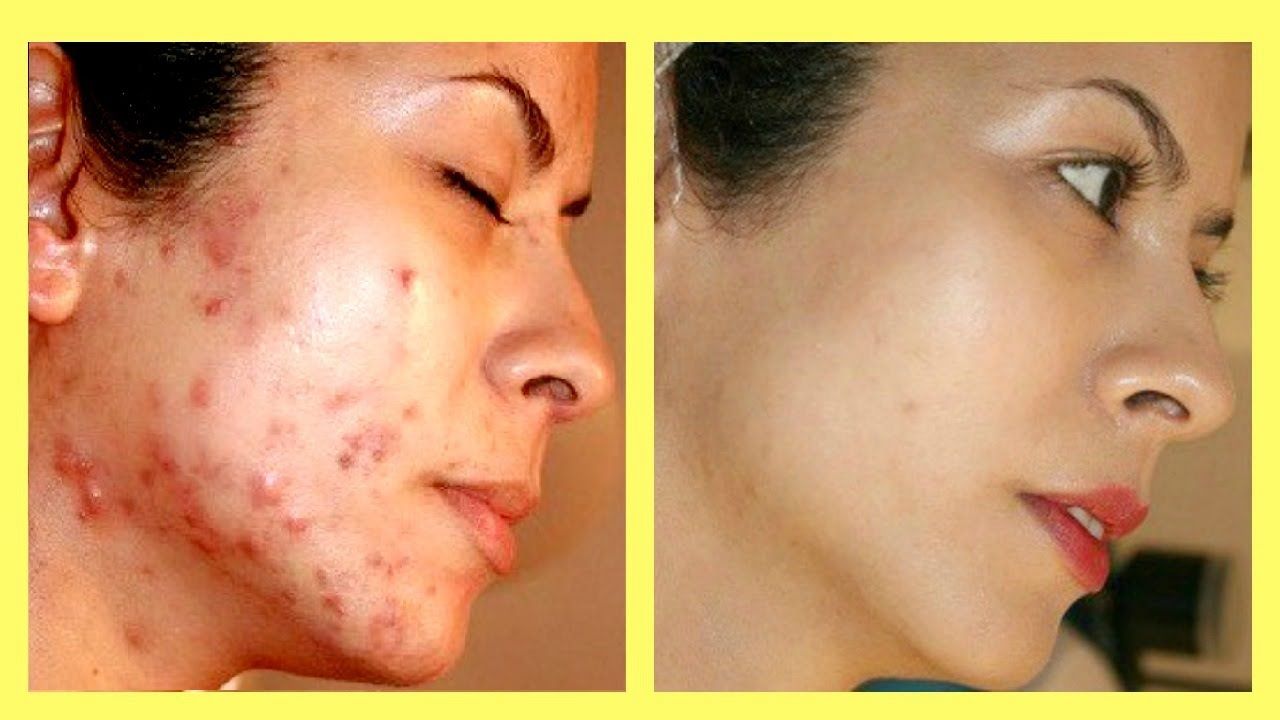 best of Scarring Prevent facial