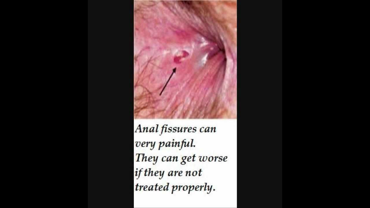 Reasons for soreness around anus