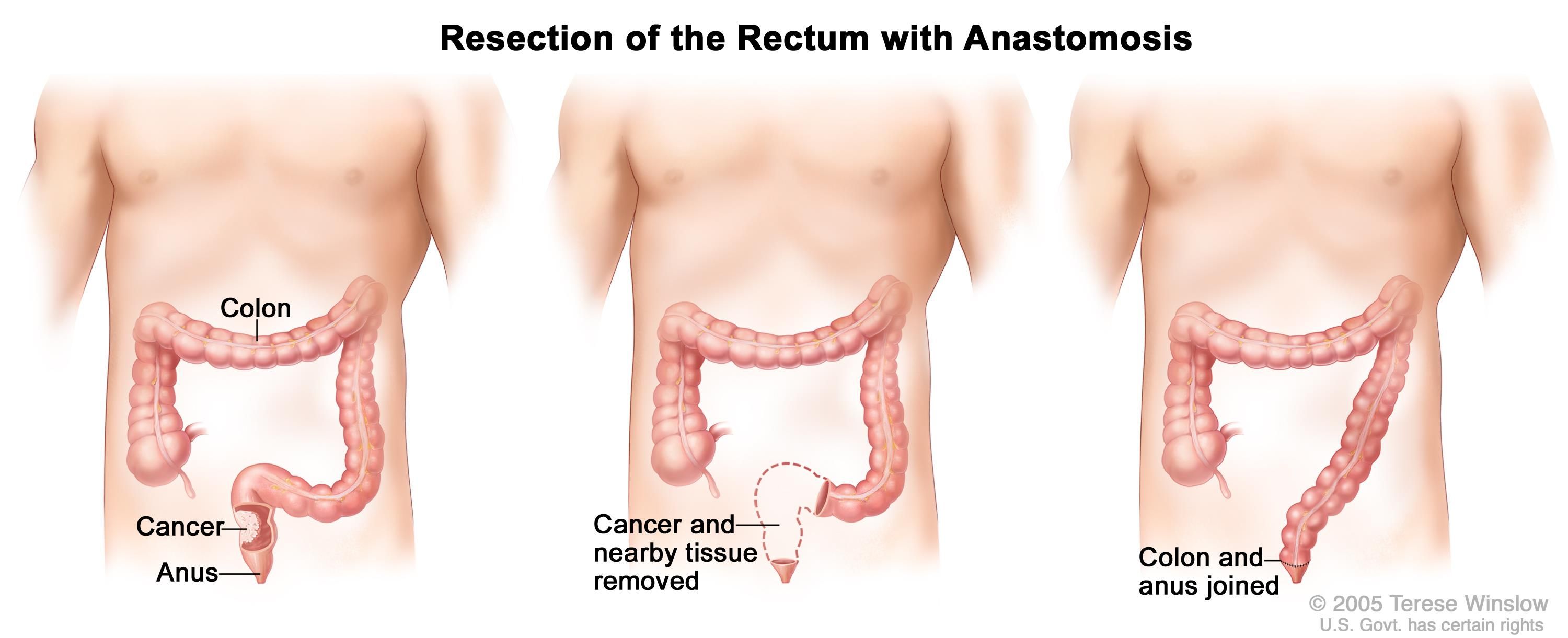 Sugar P. reccomend Surgery of the anus rectum and colon