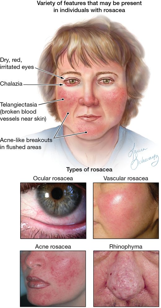 Treatment for facial rash