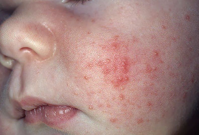 Sundance K. reccomend Treatment for facial rash